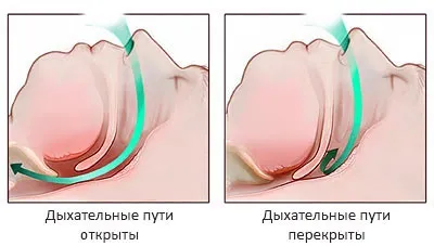 Лікування хропіння хірургічним шляхом - свідчення і види операцій від хропіння, результат (операція від хропіння відгуки) Лікування хропіння хірургічним шляхом - свідчення і види операцій від хропіння, результат