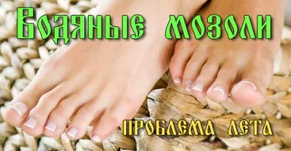 Лікування мокрій або водяний мозолі - проблема літа, лікування в домашніх умовах (водяний) Лікування мокрій або водяний мозолі - проблема літа, лікування в домашніх умовах