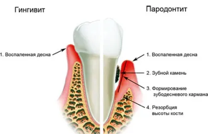 Лікування пародонтиту симптоми, фото, види (пародонтиту) Лікування пародонтиту симптоми, фото, види