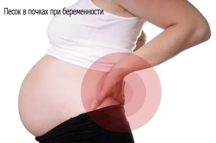 Лікування піску в нирках народними засобами (лікування) Лікування піску в нирках народними засобами
