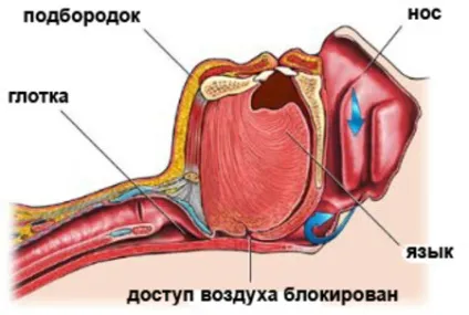 Лікування хропіння хірургічним шляхом - свідчення і види операцій від хропіння, результат (лікування) Лікування хропіння хірургічним шляхом - свідчення і види операцій від хропіння, результат