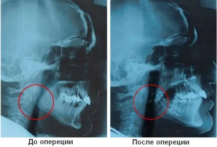 Лікування хропіння хірургічним шляхом - свідчення і види операцій від хропіння, результат (хропіння у чоловіків лікування) Лікування хропіння хірургічним шляхом - свідчення і види операцій від хропіння, результат