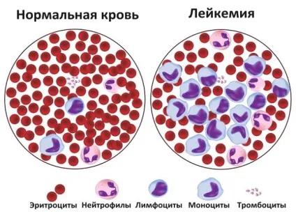 Лейкоцити в крові підвищені причини, симптоми, лікування