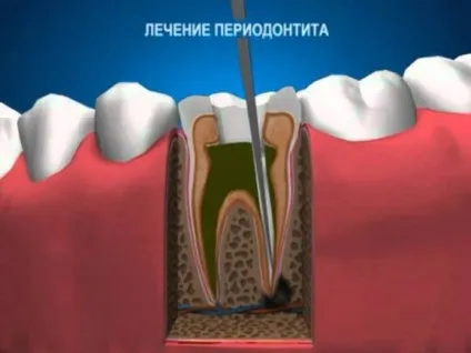 Лікування періодонтиту етапи, розріз ясна, лікування зубів