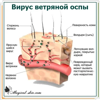 Лікування народними засобами оперізувального герпесу (лікування) Лікування народними засобами оперізувального герпесу