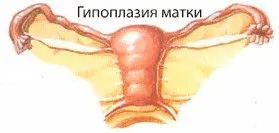 Маленька матка що це означає і чи можна завагітніти
