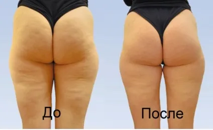 Масаж бразильські сідниці техніка проведення, попка до і після, нюанси (масаж) Масаж бразильські сідниці техніка проведення, попка до і після, нюанси