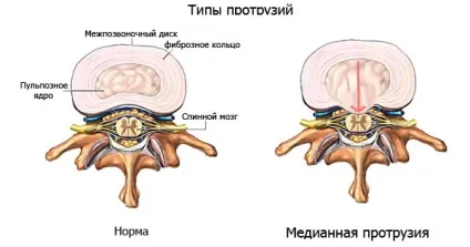 Медіанна грижа диска (l4 l5, l5 s1 і ін