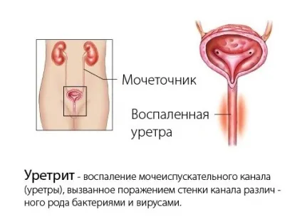 Мазок з уретри у жінок як беруть, що показує (жінок) Мазок з уретри у жінок як беруть, що показує