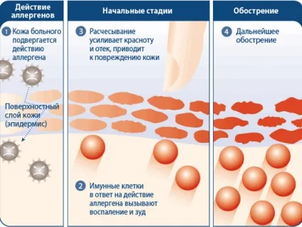 Мазі від алергії на обличчі (алергії) Мазі від алергії на обличчі