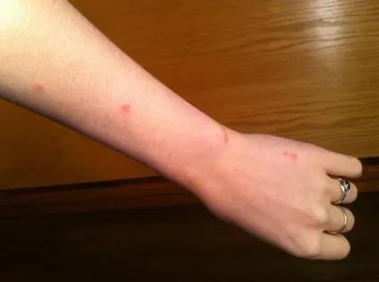 Чи можуть котячі блохи кусати людини (котячі) Чи можуть котячі блохи кусати людини