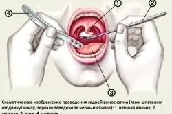 Чи можна лікувати зуби якщо болить горло (лікувати) Чи можна лікувати зуби якщо болить горло