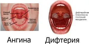 Чи можна полоскати рот перекисом водню - як правильно розводити препарат