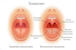 Чи можна полоскати рот перекисом водню - як правильно розводити препарат