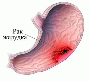 Чи можна померти від виразки шлунка