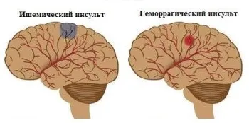 Мрт діагностика судин головного мозку (ангіографія) - опис і адреси клінік (ангіографія) Мрт діагностика судин головного мозку (ангіографія) - опис і адреси клінік