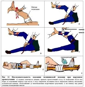 Накладення джгута