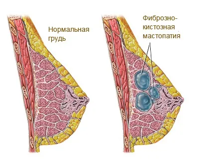 На який день циклу зробити узі молочних залоз (циклу) На який день циклу зробити узі молочних залоз