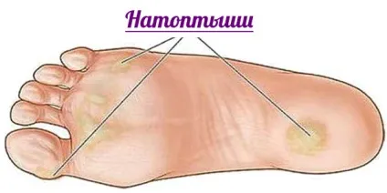 Натоптиші на підошві зі стрижнем лікування, фото ступень (натоптиші) Натоптиші на підошві зі стрижнем лікування, фото ступень