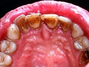 Кілька фактів про шкоду куріння для зубів, perfectsmile (куріння) Кілька фактів про шкоду куріння для зубів, perfectsmile