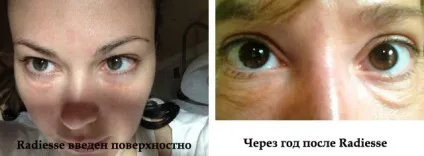 Неприємні наслідки контурної пластики і як уникнути ускладнень (контурної) Неприємні наслідки контурної пластики і як уникнути ускладнень