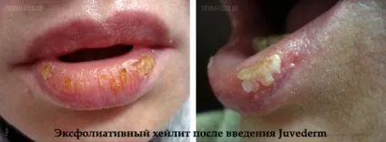 Неприємні наслідки контурної пластики і як уникнути ускладнень (уникнути) Неприємні наслідки контурної пластики і як уникнути ускладнень