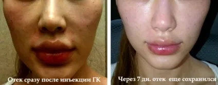 Неприємні наслідки контурної пластики і як уникнути ускладнень (контурної) Неприємні наслідки контурної пластики і як уникнути ускладнень