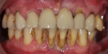 Кілька фактів про шкоду куріння для зубів, perfectsmile (кілька) Кілька фактів про шкоду куріння для зубів, perfectsmile