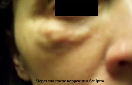 Неприємні наслідки контурної пластики і як уникнути ускладнень (наслідки) Неприємні наслідки контурної пластики і як уникнути ускладнень