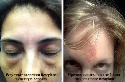 Неприємні наслідки контурної пластики і як уникнути ускладнень (неприємні) Неприємні наслідки контурної пластики і як уникнути ускладнень