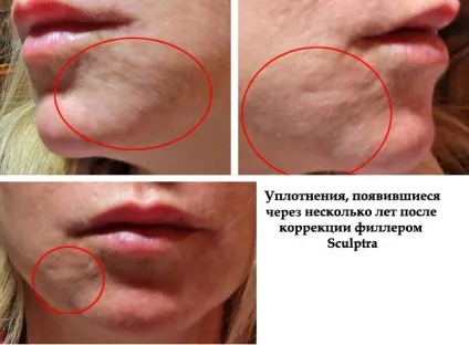 Неприємні наслідки контурної пластики і як уникнути ускладнень (контурної) Неприємні наслідки контурної пластики і як уникнути ускладнень
