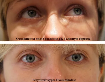 Неприємні наслідки контурної пластики і як уникнути ускладнень (ускладнення після контурної пластики профілактика наслідки) Неприємні наслідки контурної пластики і як уникнути ускладнень