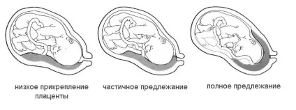 Низьке розташування плаценти при вагітності (прикріплення, передлежання, розташування) - що (вагітності) Низьке розташування плаценти при вагітності (прикріплення, передлежання, розташування) - що