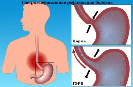 Нейровегетативная форма вазомоторного риніту - симптоми і лікування (лікування) Нейровегетативная форма вазомоторного риніту - симптоми і лікування