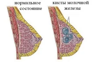 Освіта в молочній залозі з чіткими і нечіткими контурами, їх діагностика, фото і відео (чіткими) Освіта в молочній залозі з чіткими і нечіткими контурами, їх діагностика, фото і відео