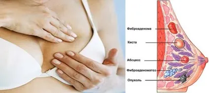 Освіта в молочній залозі з чіткими і нечіткими контурами, їх діагностика, фото і відео (молочної) Освіта в молочній залозі з чіткими і нечіткими контурами, їх діагностика, фото і відео