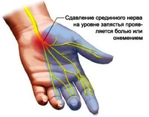 Оніміння лівої руки
