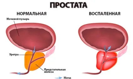 Небезпечні наслідки простатиту у чоловіків (простатиту) Небезпечні наслідки простатиту у чоловіків