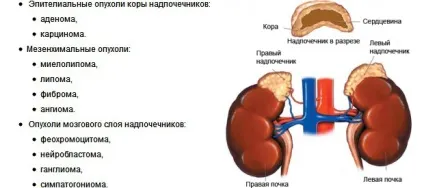 Пухлина наднирників симптоми і лікування (наднирників) Пухлина наднирників симптоми і лікування