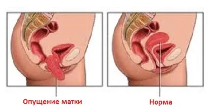 Опущення матки симптоми, причини і лікування, фото (опущення матки) Опущення матки симптоми, причини і лікування, фото