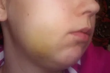 Ускладнення після видалення зуба причини і що робити (після) Ускладнення після видалення зуба причини і що робити