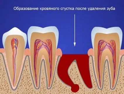 Ускладнення після видалення зуба причини і що робити (після) Ускладнення після видалення зуба причини і що робити