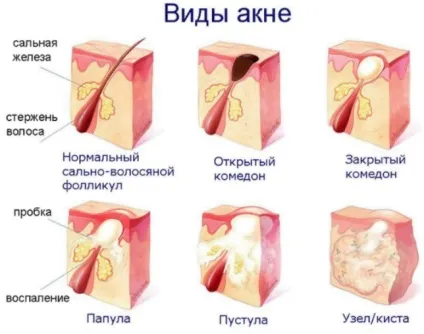 Маски від прищів в домашніх умовах - настройка здоров'я (ламінарії морські водорості) Маски від прищів в домашніх умовах - настройка здоров'я