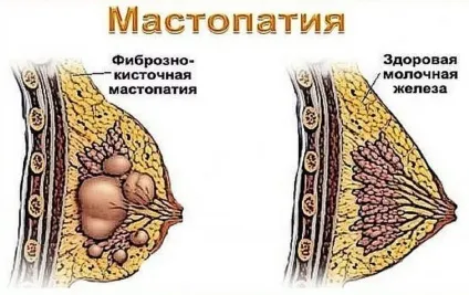Мастодинон від мастопатії як приймати препарат в таблетках і краплях (мастопатії) Мастодинон від мастопатії як приймати препарат в таблетках і краплях