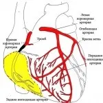 Дрібновогнищевий інфаркт міокарда