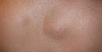 Методи як позбутися від жировик назавжди