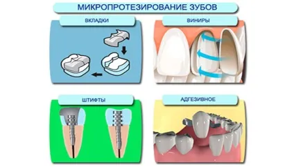 Мікропротезування - вкладки та інші види мікропротезів, ціни - стоматологічний портал (мікропротез) Мікропротезування - вкладки та інші види мікропротезів, ціни - стоматологічний портал