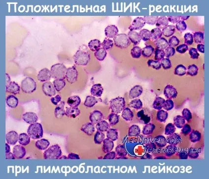 Методика шик-реакції на глікоген - оцінка результатів (методика) Методика шик-реакції на глікоген - оцінка результатів