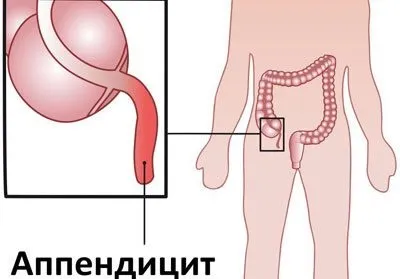 Багаторазова часта блювота у дитини причини, лікування