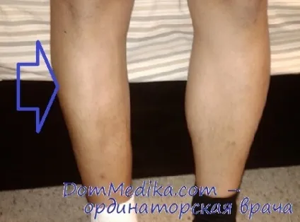 М'язова гіпотрофія при периферичному паралічі